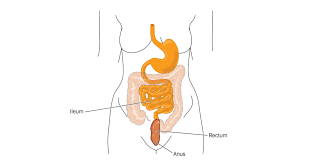 colectomy with ileorectal anastomosis