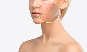 acne face mapping what can it tell