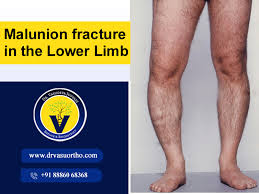 malunion fracture tibia the lower