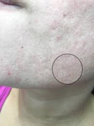 Let's see if we can help figure this out with you. Skin Concerns Tiny Bumps After Acne Not Milia Not Whiteheads Skincareaddiction