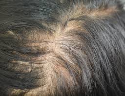 diffuse thinning signs symptoms