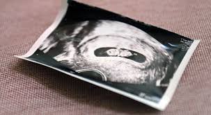 Achte woche ist schon ganz schön weit und wenn sich der embryo schon eine weile nicht mehr entwickelt. Bester Zeitpunkt Fur Den Ersten Ultraschall Von Guten Eltern