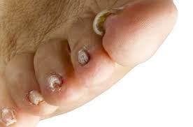 what can you expect from onychomycosis