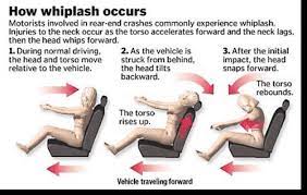 Whiplash can cause injury to intervertebral joints, discs, and ligaments, cervical muscles, and nerves. Auto Accident Bowie Md Laurel Md Allcare Chiropractic