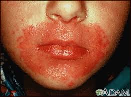 candida infection of the skin