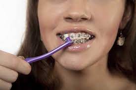 Your orthodontist might recommend gargling with salt water for quick relief and then also ask you to prioritize oral hygiene. How To Stop Braces Pain Other Braces Problems Electric Teeth