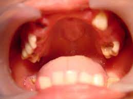 The roof of the mouth often turns yellow when a patient is suffering from oral thrush, according to allison dimatteo for the consumer guide to dentistry. Bump On Roof Of Mouth Is It A Serious Problem Tripboba Com