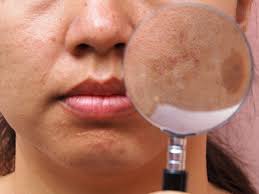 what causes pigmentation on the skin