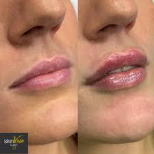 lip fillers what you need to know