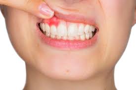 bleeding gums 9 major causes and