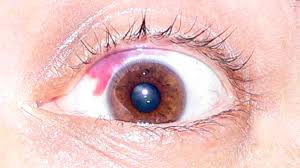 red spot on your eye when to see a