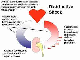 Hypovolemic Shock Nursing Care Management and Study Guide SlideShare