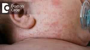 baby heat rash 6 tips for treatment