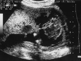 Failure to properly diagnose or. Volume 2 Chapter 50 Placental Abruption