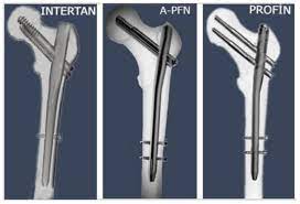 intertrochanteric fem fractures