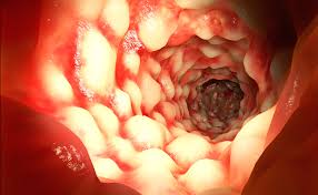 Crohn disease versus ulcerative colitis. Colonoscopy And Inflammatory Bowel Disease Ibdrelief