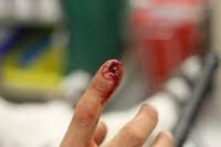 finger nailbed laceration repair