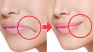 fix droopy mouth corners remove fat