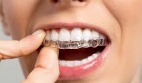 Food gets stuck, wires get. Can You Fix An Overbite With Invisalign Fine Orthodontics Blogfine Orthodontics Blog