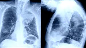How is lung cancer diagnosed? How Quickly Does Lung Cancer Spread Your Faqs