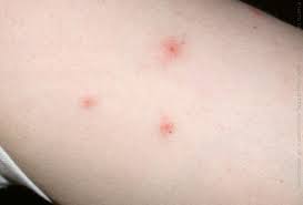 Bed bug bites are similar to chigger bites. Bed Bug Bites Picture Of What Bed Bug Bites Look Like