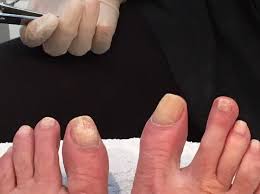 how to diagnose toenail fungus toenail