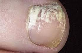 on toenails fungus or dehydrated nails