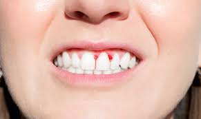 reversing periodontal disease the