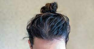 oily scalp causes treatment and