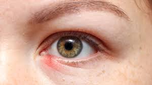 what causes a stye risks and how can