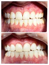 teeth whitening western dental hygiene