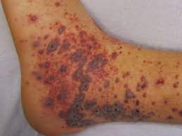 Purpura are purple or red spots on the skin or mucus membranes. Purpura Vs Petechaie Differences Causes And Treatments