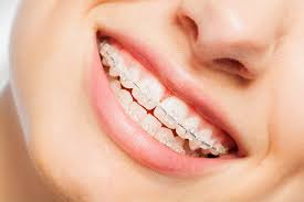 Do you have gaps in your teeth? Diastema Gap Teeth Causes And How To Fix Gap Teeth Living Well Dental Group
