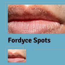 fordyce spots fordyce spot removal