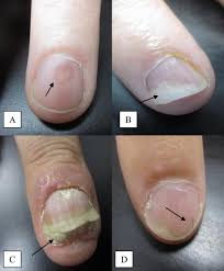 psoriatic arthritis and nail changes