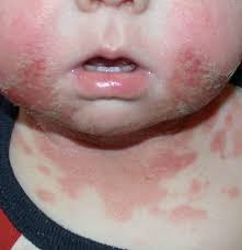 drool rash treatment prevention and