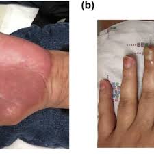 a well demarcated palmar erythema and