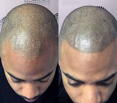 scalp micropigmentation scalp