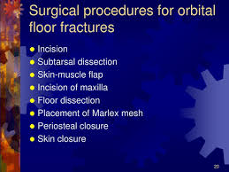 ppt orbital fractures powerpoint