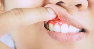 It commonly occurs because a film of plaque once you have braces, it is quite easy to develop gingivitis. What Are The Different Stages Of Gum Disease
