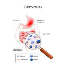 gastroenteritis stomach flu dhp