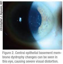 Recurrent corneal erosions and epithelial basement membrane dystrophy. When And How To Treat Ebmd