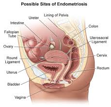 In this review of recent publications, the principal symptoms of the disease, pain and infertility, as well as its pathogenesis … Endometriosis What Is Endometriosis Endometriosis Symptoms Treatment Diagnosis Ucla