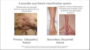 keloid scar laboratory department of