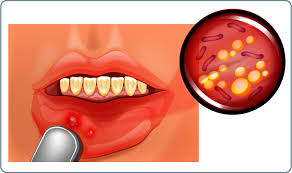 Mundfäule tritt meistens bei kleinkindern im alter zwischen 10 monaten und 3 jahren auf; Mundfaule Symptome Behandlung Vorbeugung Mooci