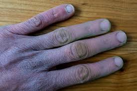 purple hands raynaud s symptoms