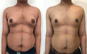 gynecomastia male t surgery