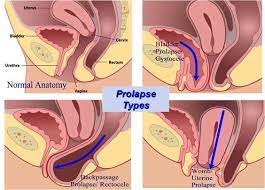pelvic organ prolapse 50 of women who