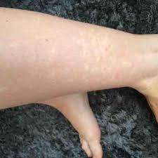 white blotchy rash on legs see picture