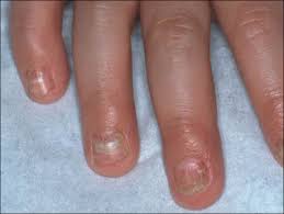 pediatric nail diseases clinical